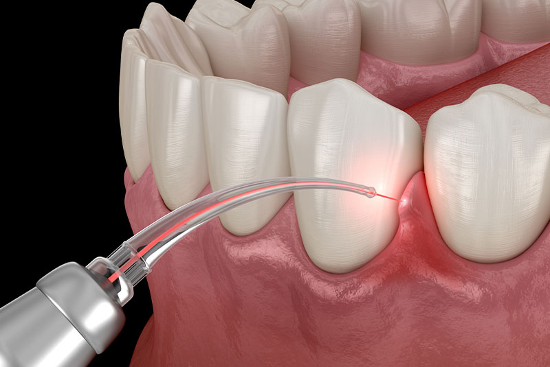 Dental Laser